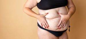 Myth: PCOD affects only overweight women